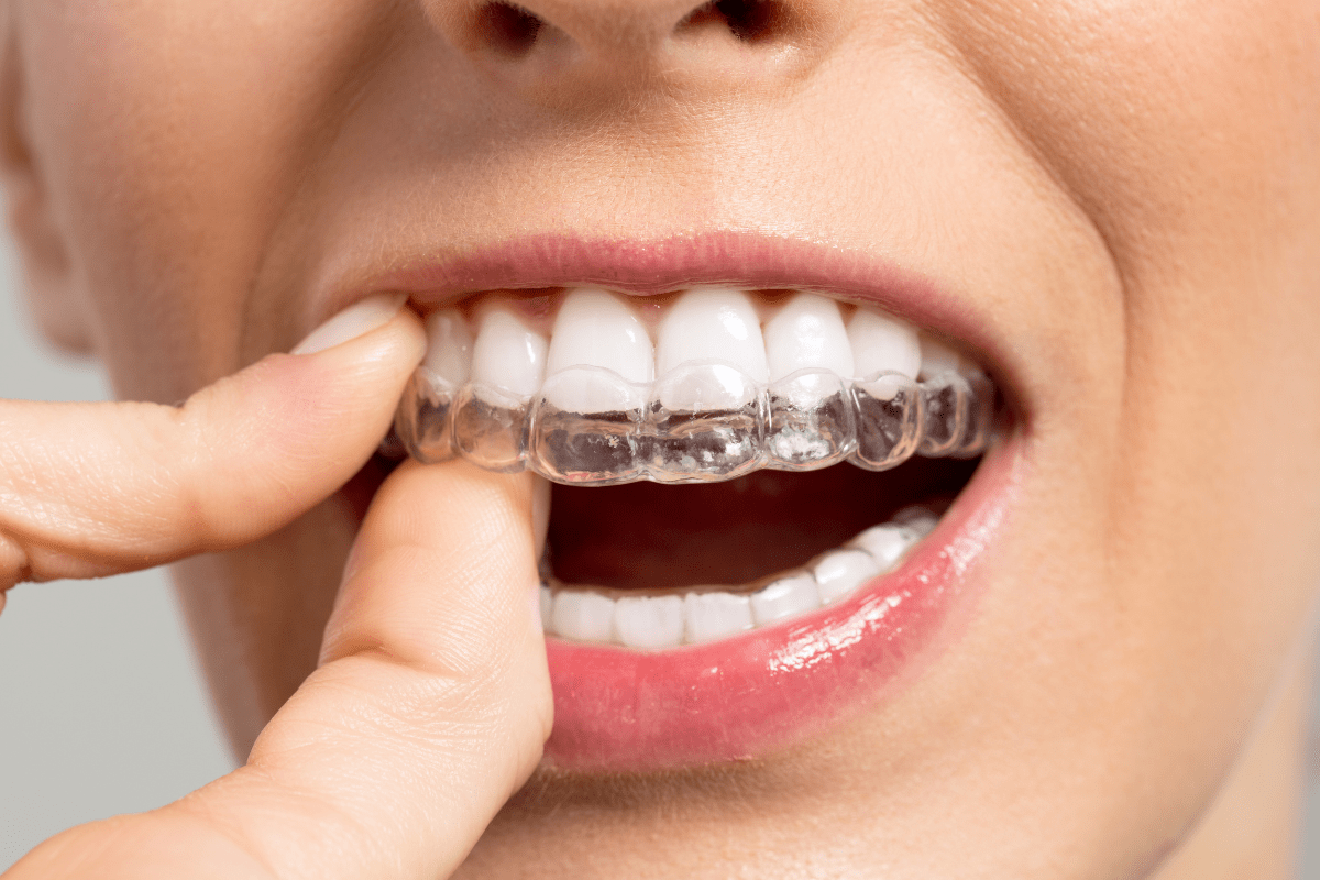 braces: invisible aligners