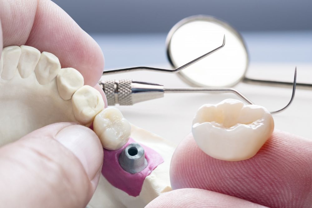 dental_bridge